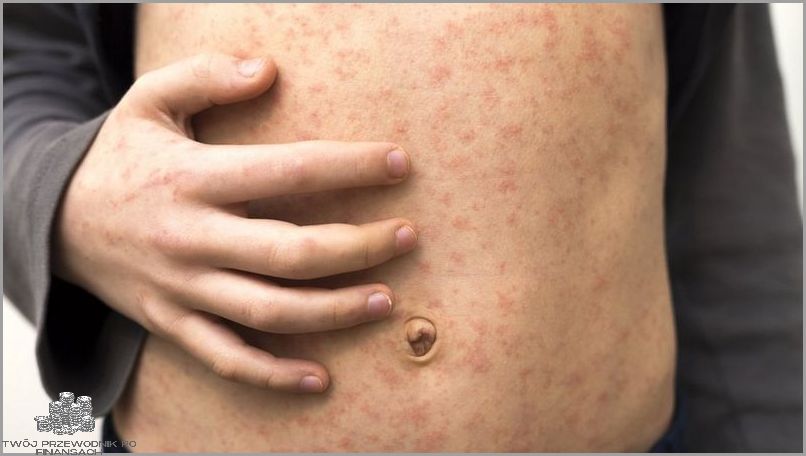 Uwaga Rodzice: Objawy Covid U Dzieci!